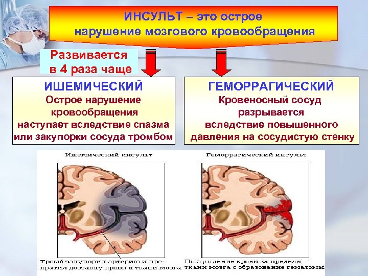 Нарушение мозгового кровообращения типы